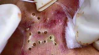 Big Cystic Acne Blackheads Extraction Blackheads amp Milia Whiteheads Removal Pimple Popping 086 [upl. by Jentoft]