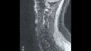 Cspine MRI withwithout contrast [upl. by Dahcir415]