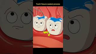 Tooth fissure sealant process [upl. by Ileane]