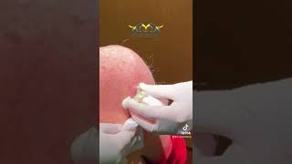 Close up amp Short Cyst 🌋 Video from Las Vegas Dermatology [upl. by Ninnetta]