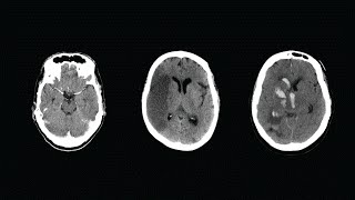 How to Read a CT Scan of the Head  MEDZCOOL [upl. by Sharpe26]