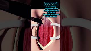 Tracheostomy Procedure doctor practical tracheotomy tracheostomy trendingshorts [upl. by Hannad]