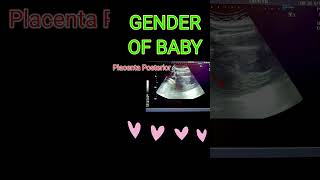 BABY GENDER VS PLACENTA shortsfeedpregnancy [upl. by Anitsirhcairam]