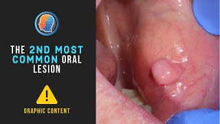 Second Most Common Oral Lesion  Fibroma [upl. by Hasile468]