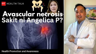 Avascular necrosis Sakit ni Angelica P Ano ito Causes risks symptoms and treatment [upl. by Mcilroy]