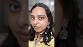 Skin Transformation Acne to Clear skin shorts skincare beauty [upl. by Llewop]