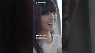 Nanas Invisalign Transformation  Invisalign India invisalignsmile [upl. by Kir]