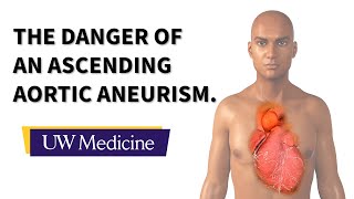 Surgeon describes an ascending aortic aneurysm  UW Medicine [upl. by Suoicerp]