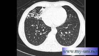 CT Chest  How to differentiate between pulmonary arteries and veins [upl. by Acisej]