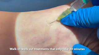 Microsclerotherapy for thread veins [upl. by Pepper234]