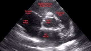 Parasternal Short Axis View Aortic Level  Loop [upl. by Oinolopa]