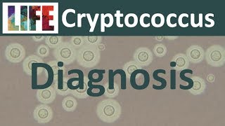 Diagnosing cryptococcal meningitis [upl. by Maitund]