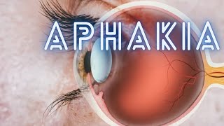 Aphakia  Ophthalmology Lecture [upl. by Anima]