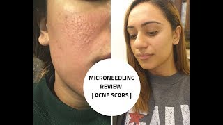 MICRONEEDLING REVIEW  Acne Scars  Before and After  PART 1 [upl. by Eelame]