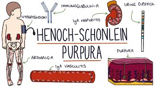 HenochSchonlein Purpura Visual Explanation for Students [upl. by Ycnay]