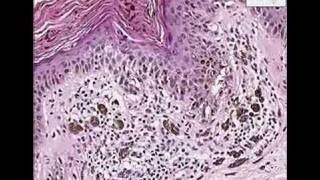 Histopathology SkinLentiginous junctional nevus hypermela [upl. by Abad250]