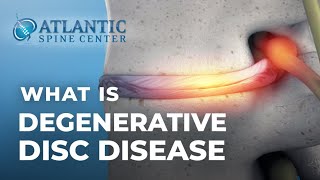 What Is Lumbar Degenerative Disc Disease  Intervertebral Disc Height Loss [upl. by Margo]