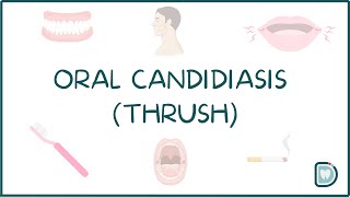 Understanding Oral Candidiasis or Oral Thrush [upl. by Lenny216]