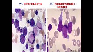 Acute Leukemia [upl. by Ahsram]