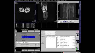 MR Venography  Lower Extremity MRI MRV MRA siemens technique [upl. by Cissy]