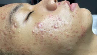 ACNE TREATMENT VU QUYNH MI  Blackheads Perennial EveryWhere Squeeze Chin [upl. by Eekram]