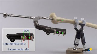 Femur Proximal  Fracture  Intramedullary Fixation Using the Expert RAFN  Antegrade Procedure [upl. by Ennaej]