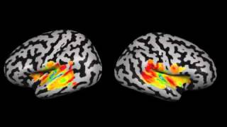 Cochleotopic Mapping of Human Auditory Cortical Fields [upl. by Derfliw170]