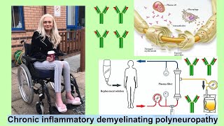 chronic inflammatory demyelinating polyneuropathy [upl. by Niloc]