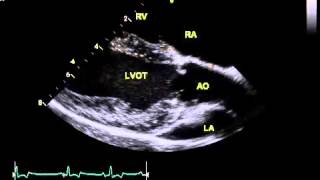 Normal canine echo  right parasternal long axis LVOT view [upl. by Eidod702]