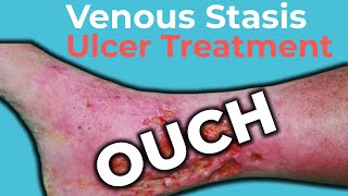 Venous Stasis Ulcer Treatment  Wound Care OC [upl. by Odlanyer143]