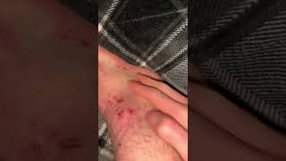 short video of foot scratching eczema asmr [upl. by Devland96]