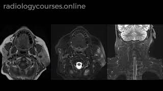 Acute Sialadenitis [upl. by Valtin388]