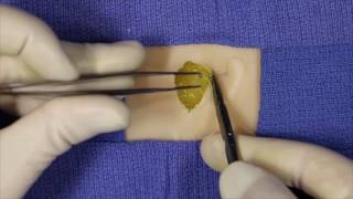 Fascial Plication Suture [upl. by Rich]