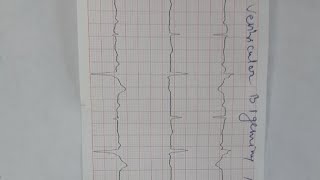 ventricular bigeminy and trigeminy [upl. by Wes23]