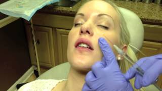 Botox amp Juvederm Lip Injection in Virginia by Dr Naderi DC VA MD [upl. by Rekoob742]