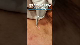 흑자제거 한번에 흑자제거skincare lentigovlog laser [upl. by Llehcor]