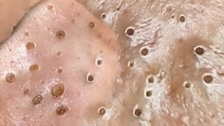 Deep Big Removal Of Blackheads Ear Nose [upl. by Boccaj]