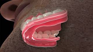 DenSureFit for Lower Denture [upl. by Ohnuj473]