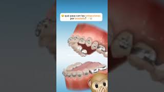 premolar extraction for orthodontic treatment ортодонтия kieferorthopädie ortodonzia orthodontie [upl. by Barolet]