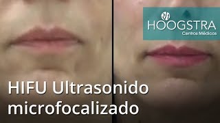 HIFU Ultrasonido microfocalizado 18243 [upl. by Aimas489]