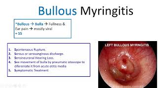 Diseases of Tympanic Membrane Otitic Barotrauma Bullous Myringitis amp Granular Myringitis [upl. by Ahola]