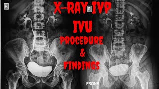 XRAY IVP  XRAY IVU Procedure Indications Findings  Intravenous Urogram  Intravenous Pyelogram [upl. by Allisan]