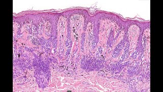 Dysplastic nevus re visited 2024 McKee [upl. by Ciredor]