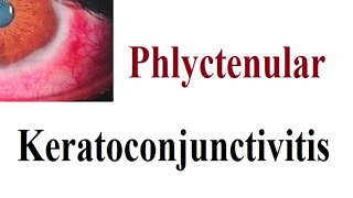 phlyctenular Keratoconjunctivitis [upl. by Seitz]