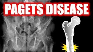 Paget Disease of Bone radiology doctor bones [upl. by Bel]