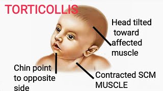 Torticollis  Clinical of Sternocleidomastoid [upl. by Annaillil]