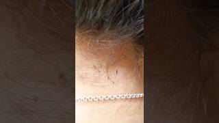 Lice Removal Part 5 shots funny [upl. by Ahsitnauq61]