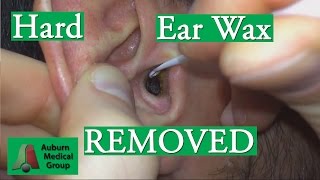 Hard Ear Wax Cerumen Removal with a Curette  Auburn Medical Group [upl. by Amelia]