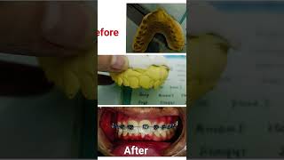 Orthodontics treatment 45 month progress ortholearning orthodontics [upl. by Samoht608]