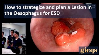 How to strategize and plan a Lesion in the Oesophagus for ESD [upl. by Eitsud]